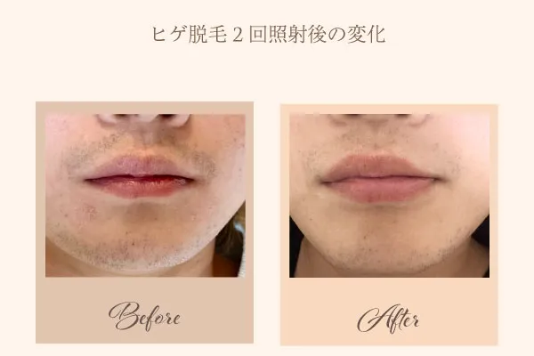 ヒゲ脱毛 2回照射