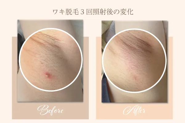 ワキ脱毛 計3回照射